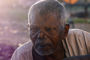 Detectan caso de lepra en Chile