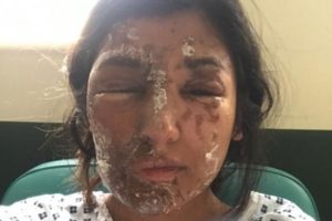 Alarmante cifra en Reino Unido: policía reportó 400 ataques con ácido en seis meses