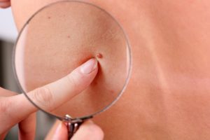Melanoma: el agresivo cáncer de piel cuya mortalidad va en aumento