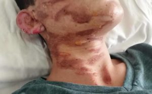 Colegio de La Ligua culpa a alumno por explosión que dejó a joven con quemaduras
