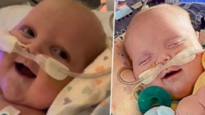 EEUU: la primera sonrisa de un bebé tras ser operado dos veces del corazón