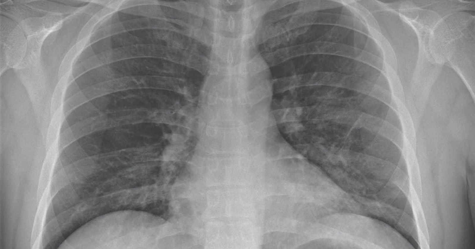 coronavirus pulmones