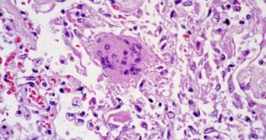 La historia del SARS, el pariente lejano del COVID-19 que se logró contener