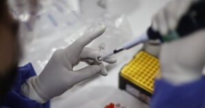 Confirman primer caso de viruela del mono en Antofagasta