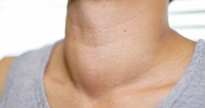 Cáncer de tiroides: la importancia de un diagnóstico y un tratamiento tempranos