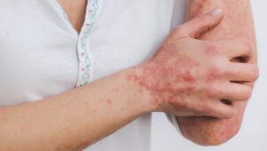 Startup chilena crea crema corporal que disminuye la psoriasis hasta en un 98%