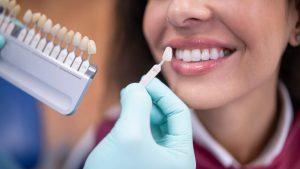Blanqueamiento dental: expertos advierten riesgos de hacerlo sin indicación médica