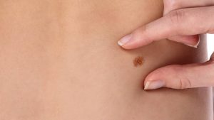 Chequea tus lunares de forma gratuita para detectar y prevenir el cáncer de piel