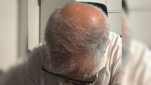 Cuál es el fármaco para la calvicie que hizo levantar una alerta al ISP: los peligros que conllevaría