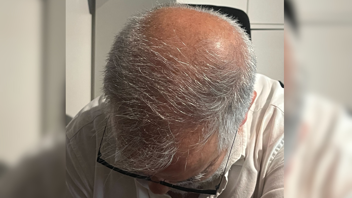 Cuál es el fármaco para la calvicie que hizo levantar una alerta al ISP: los peligros que conllevaría