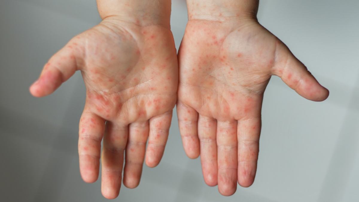Alerta por aumentos del virus Boca, Mano y Pie en el país: conoce sus síntomas y cómo prevenirlo