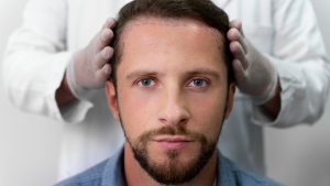 Implantes Capilares en Chile: la tendencia estética que pone fin a la inseguridad masculina y conquista a los famosos