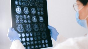 Estudio clínico en Estados Unidos logra frenar el Alzheimer: cómo se consiguió el avance