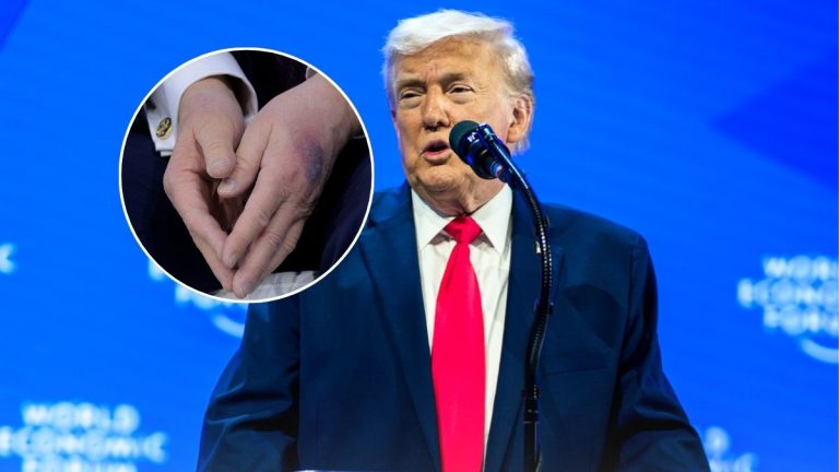 Qué son los moretones en las manos de Trump: sus explicaciones y antecedentes médicos