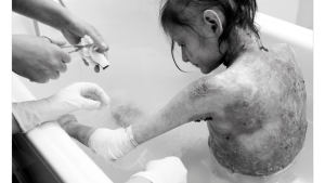 La campaña de fundación que busca seguir tratando a los pacientes con Piel de Cristal