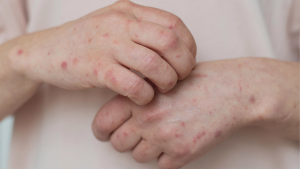 Sífilis y gonorrea registran tasas de contagio más altas de la década en Chile: ¿qué explica el aumento?